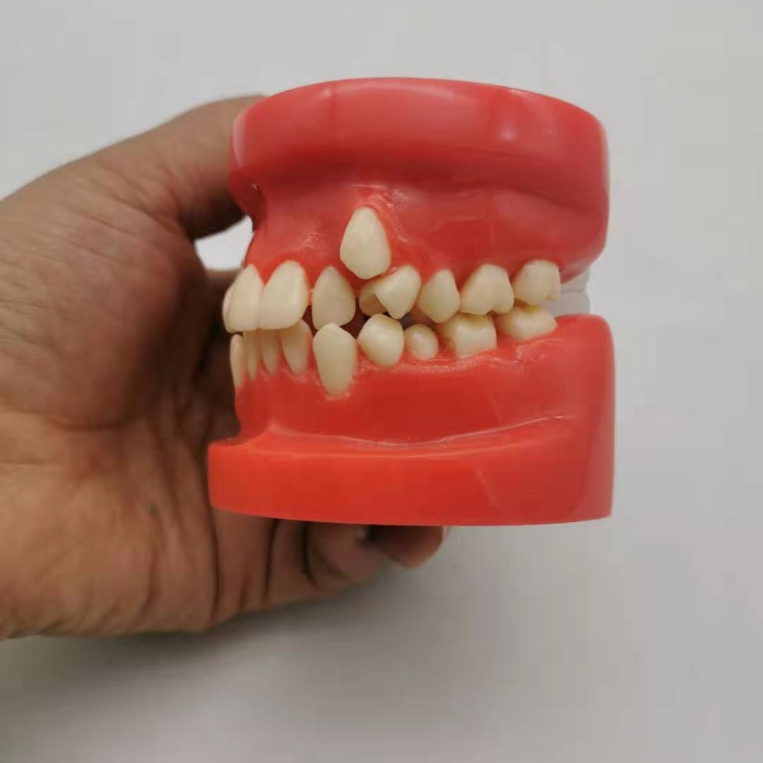 Dental red wrong jaw model oral teaching model children wrong jaw model dental wrong jaw buck teeth
