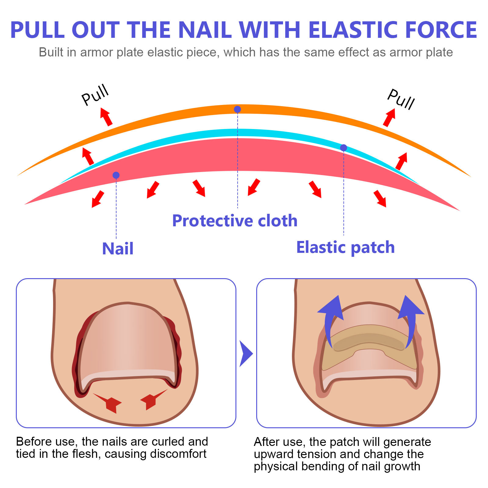 SEFUDUN nail groove inflammation correction patch ingrown nail correction piece Lala anti-tension paste-free corrector