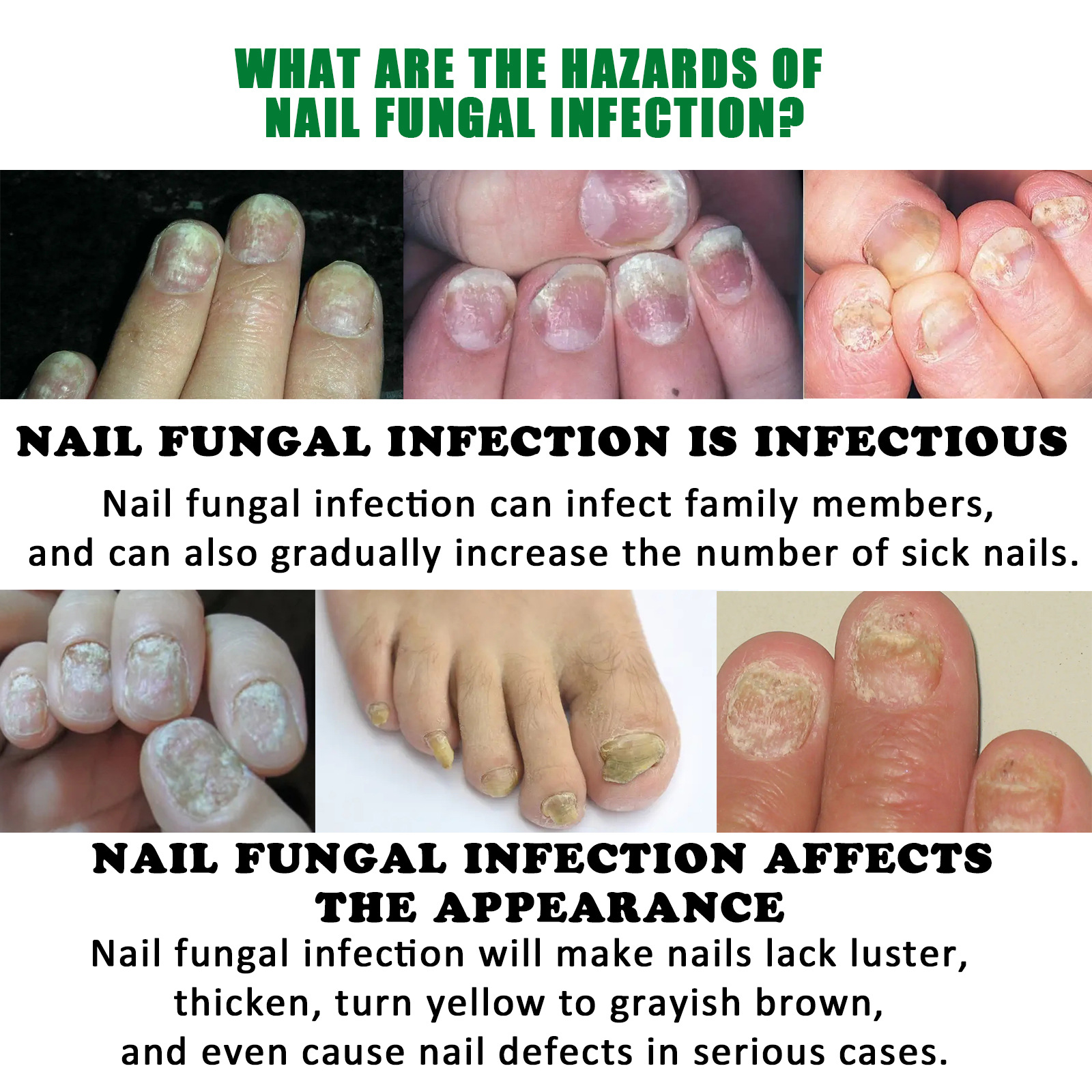 Jaysuing ginger nail care solution care soft nail bright nail gray nail repair hand and foot nail nourishing liquid