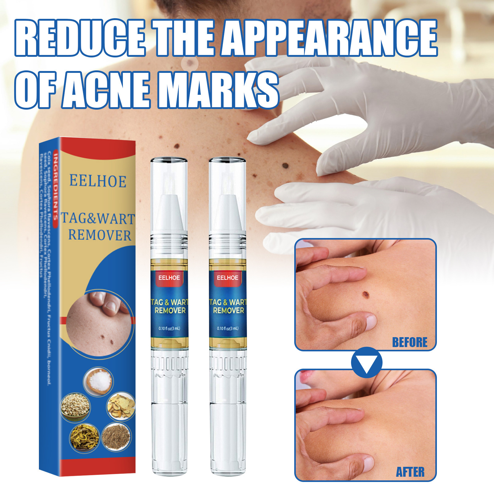 EELHOE skin wart removing mole pen removing liquid body skin wart nursing skin repair care solution