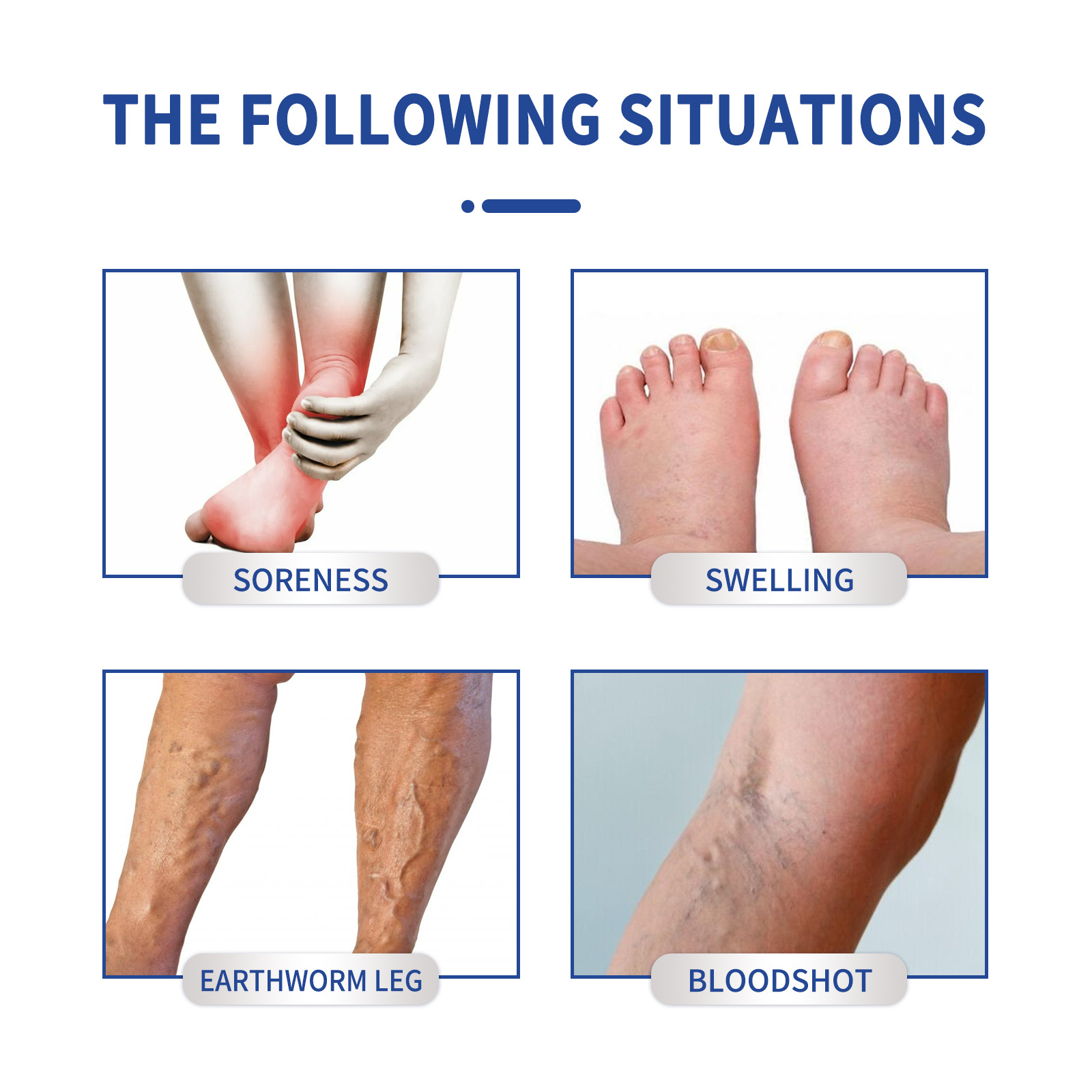South Moon vein massage Qu Zhang cream relieve leg vascular bulge vein Qu Zhang earthworm leg repair