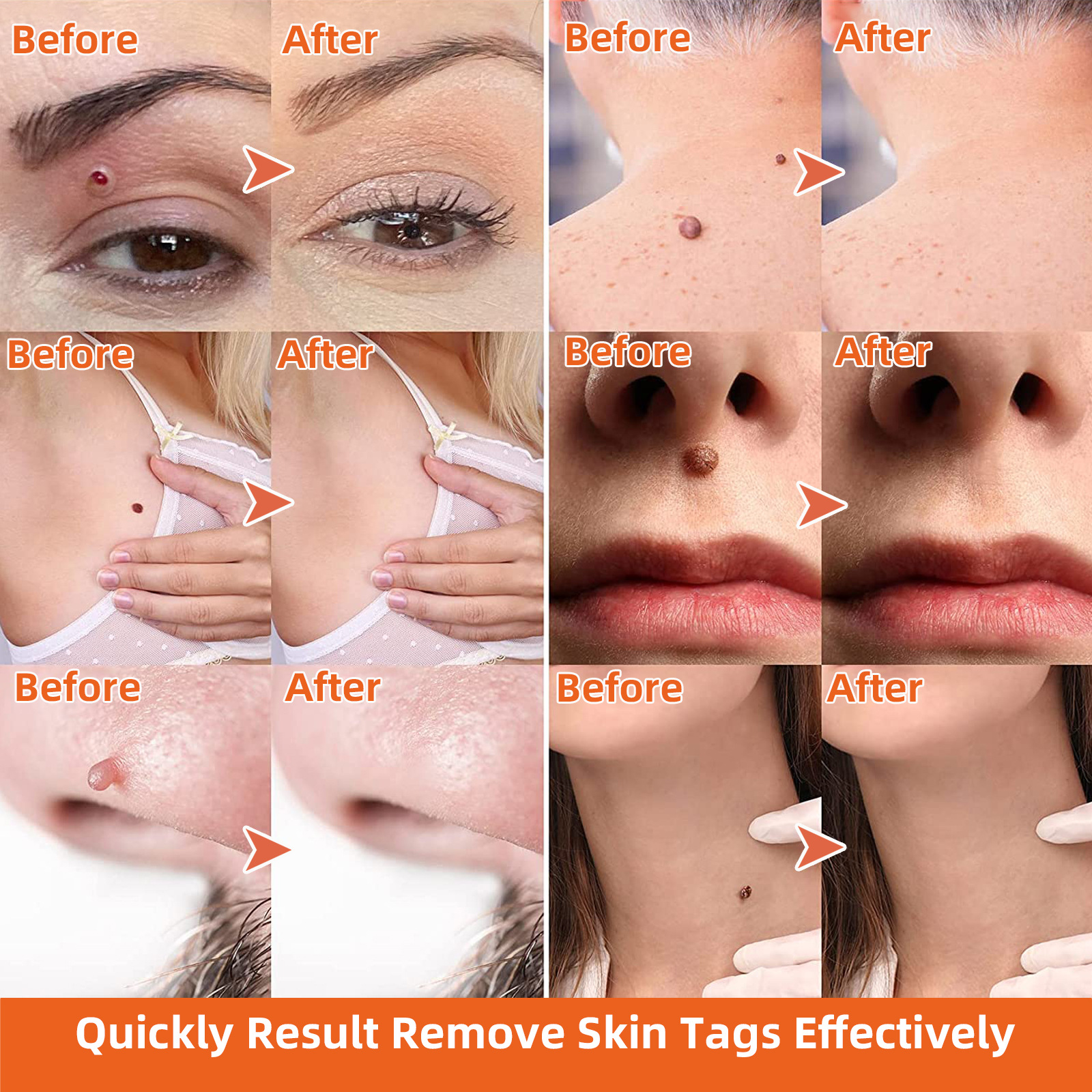 Tagband Skin Tag rubber removing moles removing corns removing wart removing Skin lifting device (including repair stickers)