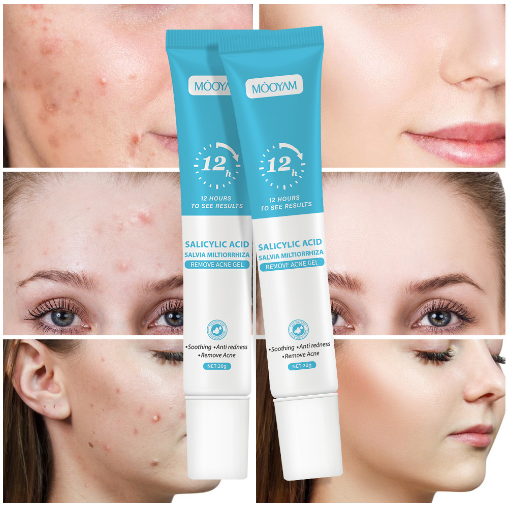 Cross-border salicylic acid acne cream to fade acne marks to eliminate acne and shrink pores plant essence acne gel