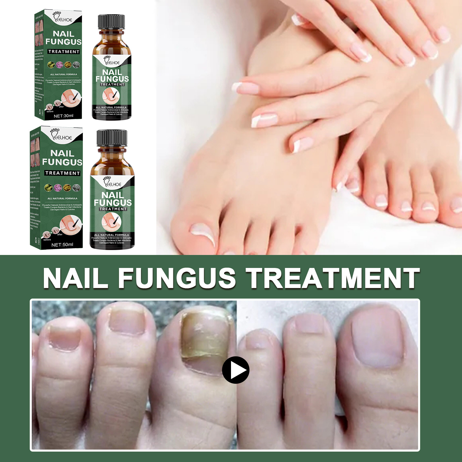 EELHOE Nail Repair Solution Hand & Foot Repair Solution Gray Nail Solution Uneven Thick Nail Thickening Type Gray Nail Soft Nail