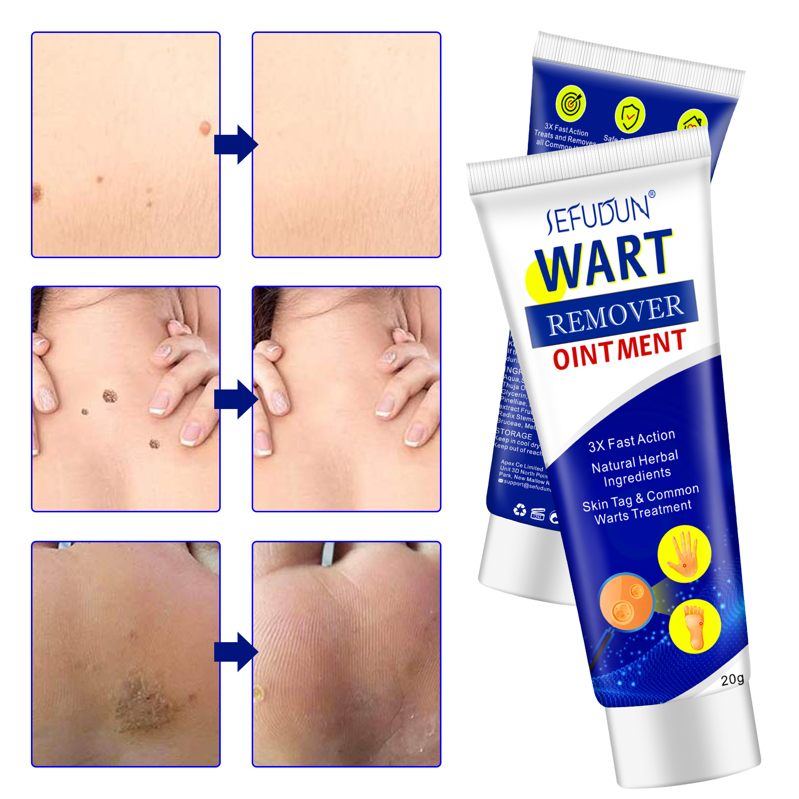 SEFUDUN wart cream wart removal cream repair and cleansing skin normal Yuke body face youcream 20g