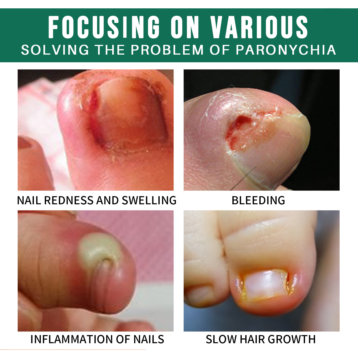 Cross-border nail repair solution nail care hands and feet Nail Repair Moisturizing cleaning nail removal solution wholesale