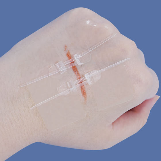 Hongsheng Tension Reducer Suture-free Wound Suture Suture Zipper Band-wound Patch Skin Reduction Post-dressing for Children