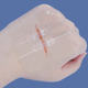 Hongsheng Tension Reducer Suture-free Wound Suture Suture Zipper Band-wound Patch Skin Reduction Post-dressing for Children
