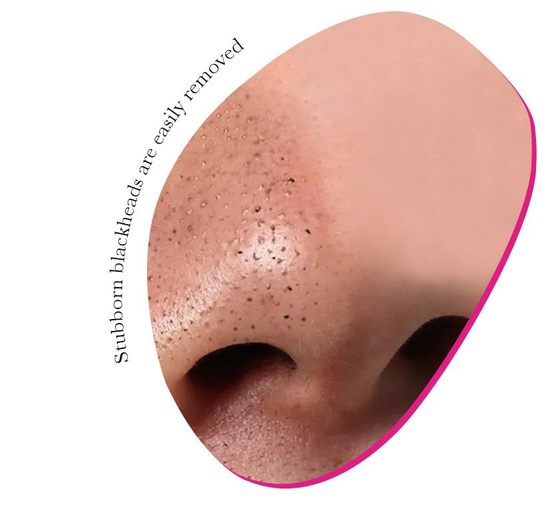 ROSOTENA bamboo charcoal blackhead acne removing NOSE mask nasal patch NOSE STRIPS 10PCs
