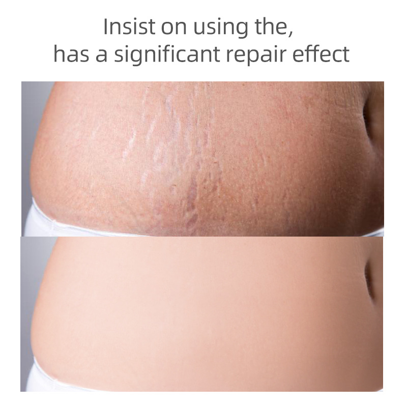 Cross-border Foreign Trade Mummy's cream Pre-Natal and Post-Natal Pregnancy Stretch mark Remove cream
