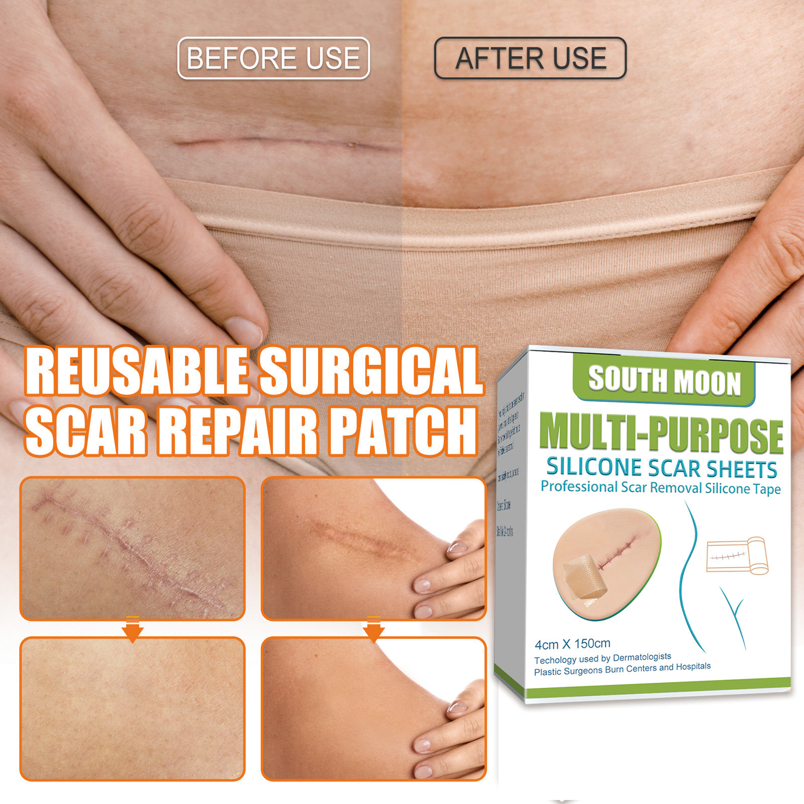 South Moon Silicone Gel Scar Patch for Desalination and Repair Skin Pregnancy Smoothing Skin Surgical Scar Patch