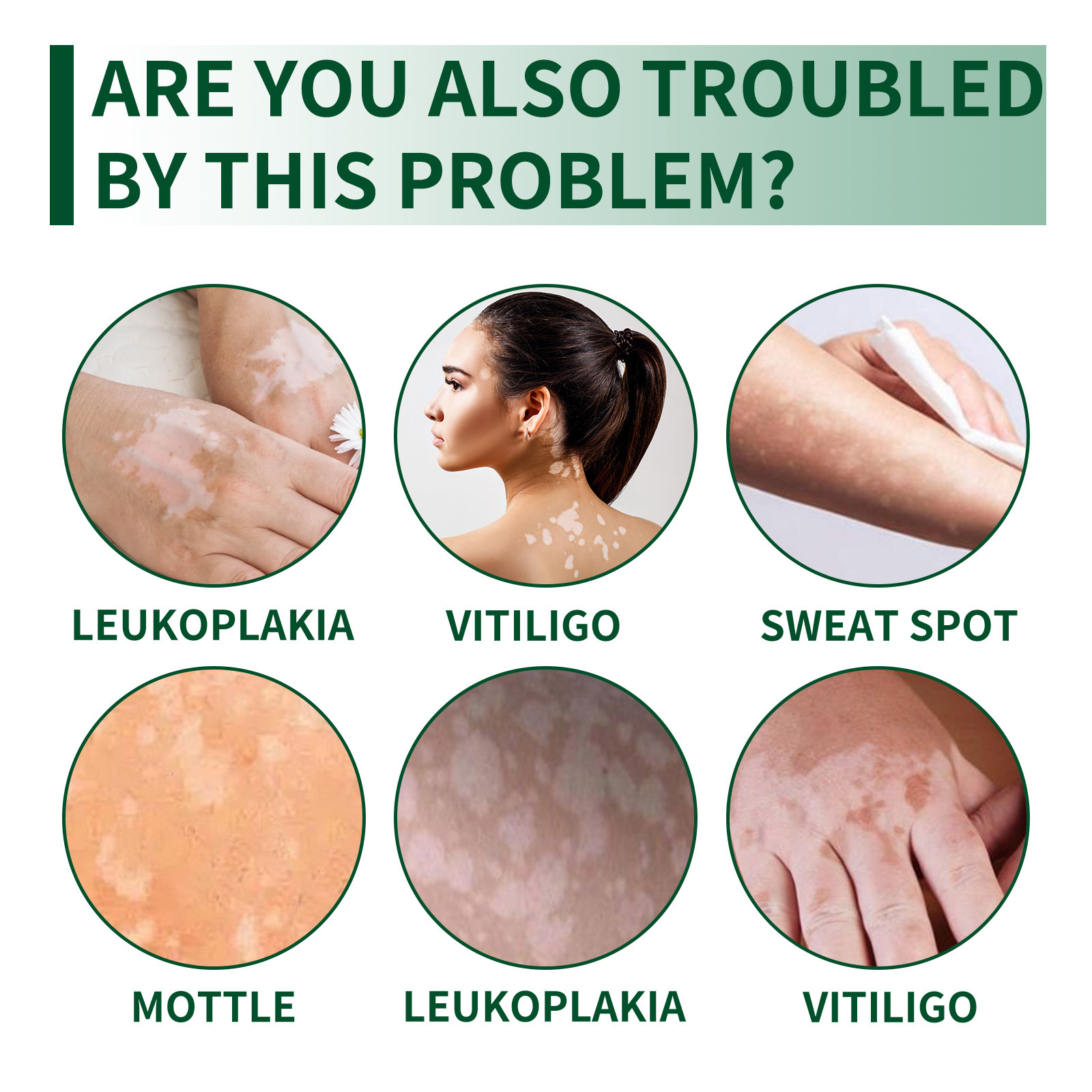 South Moon white spot care cream white spot sweat spot flower spot body skin care external skin care cream
