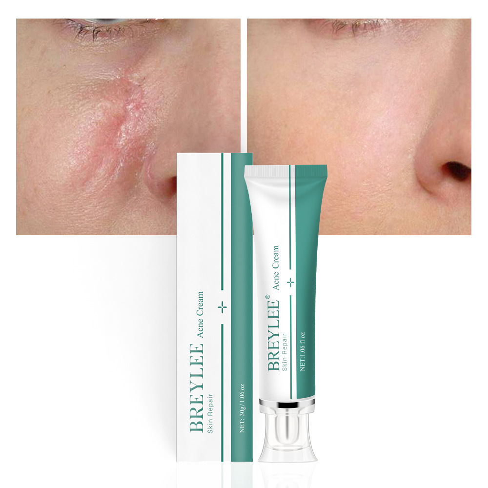 BREYLEE Acne Scar Removal Cream herbal skin Cream repair gel 30g
