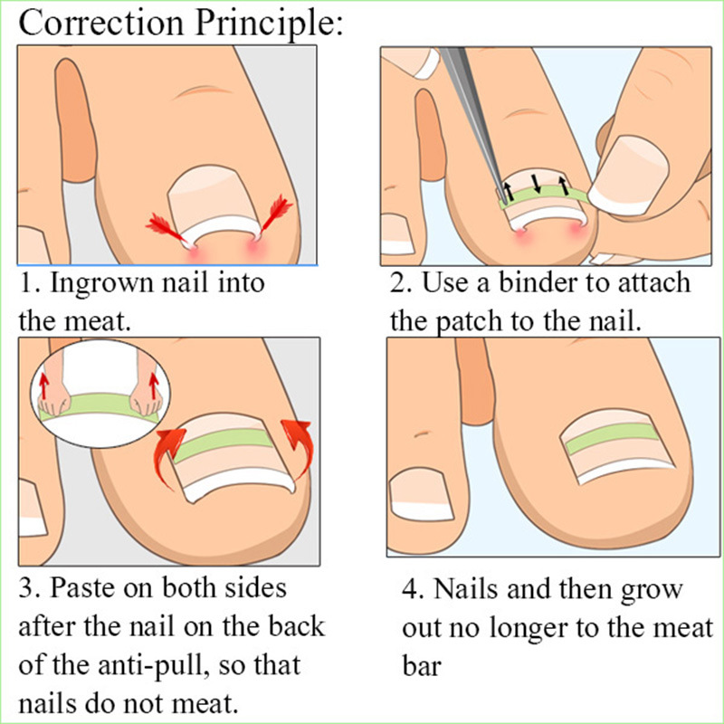 Factory Burr-free fine polishing nail paste nail pad nail correction patch nail correction device pedicure tool