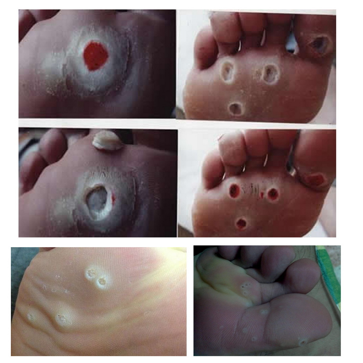 Suit corns paste corns paste remove hard calluses old calluses wart hand and foot Cocoon foot pad foot ease manufacturer