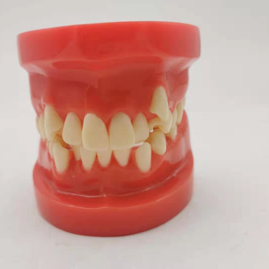 Dental red wrong jaw model oral teaching model children wrong jaw model dental wrong jaw buck teeth