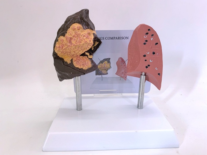 比較モデル 喫煙肺 健康肺の解剖学 病理学モデル 呼吸器系の病気|undefined